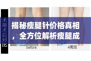 揭秘瘦腿針價(jià)格真相，全方位解析瘦腿成本！