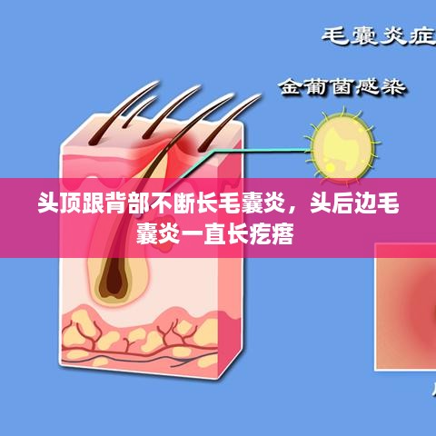 頭頂跟背部不斷長(zhǎng)毛囊炎，頭后邊毛囊炎一直長(zhǎng)疙瘩 