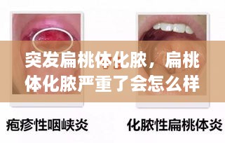 突發(fā)扁桃體化膿，扁桃體化膿嚴(yán)重了會(huì)怎么樣了 