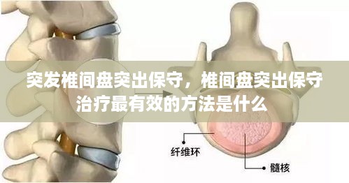 突發(fā)椎間盤突出保守，椎間盤突出保守治療最有效的方法是什么 