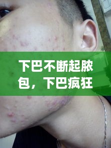下巴不斷起膿包，下巴瘋狂長膿包 